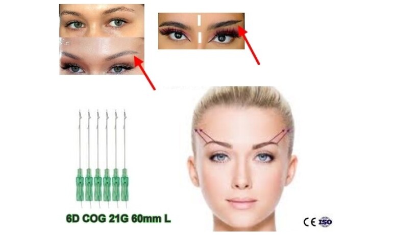 PDO Fäden COG 6D 21G 60mm L-Typ Stumpf (Augenbrauenlift,Jawline,Gesicht)
