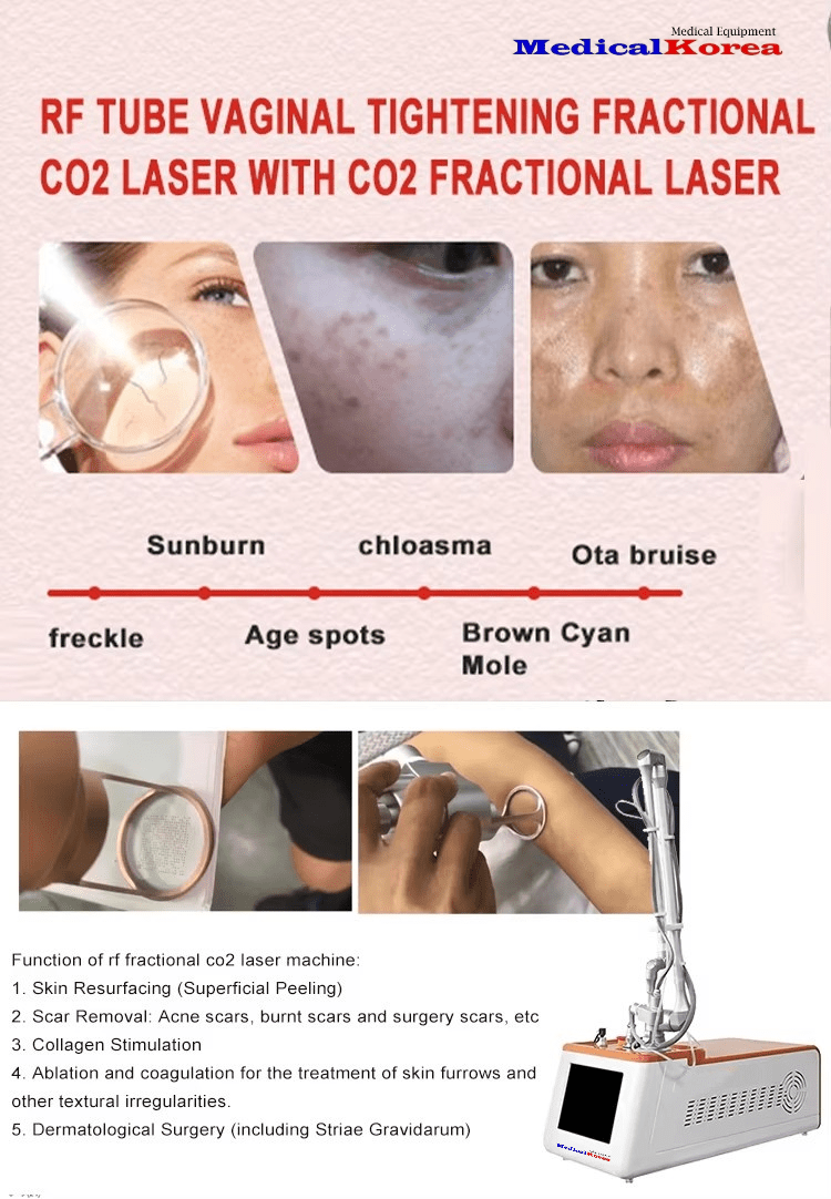 CO2 Fraktionierter Laser – Bild 7