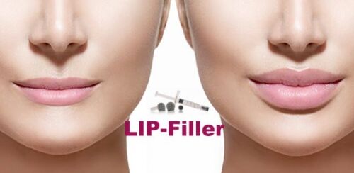 LIPS & Nasolabial Filer 2ml Hyaluron Filer Lippenaufbau – Bild 2
