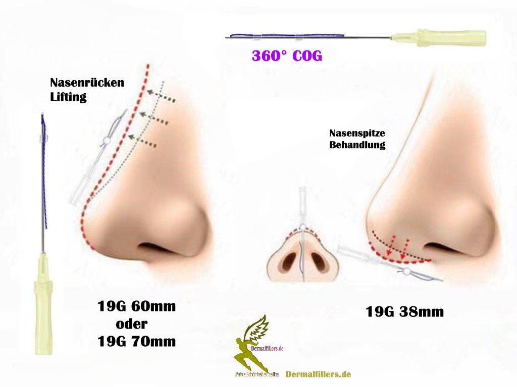 PDO Fäden,Nasenlift,Nasenkorrektur COG 19G X 60mm L-Typ Stumpf – Bild 3