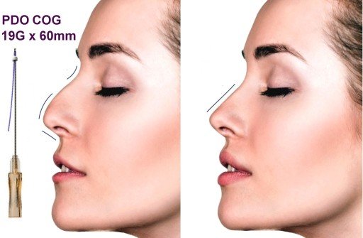 PDO Fäden,Nasenlift,Nasenkorrektur COG 19G X 60mm L-Typ Stumpf – Bild 2