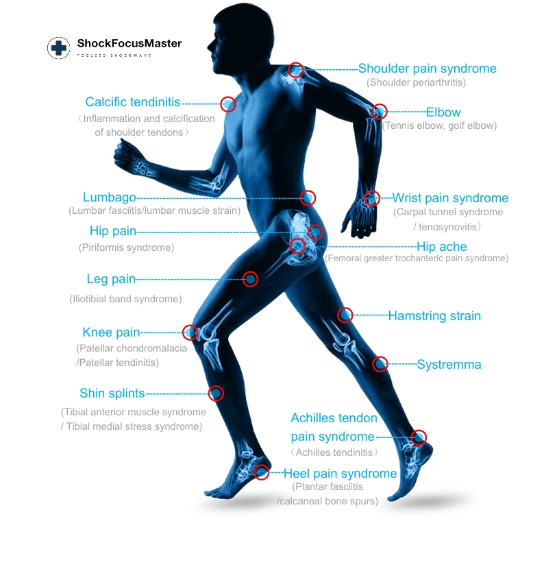 Stosswellentherapiegerät, ShockFocusMaster – Bild 4